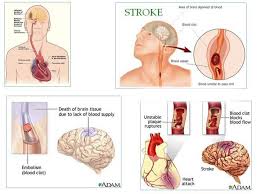 penyakit stroke